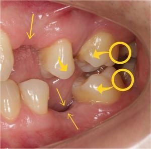 Misalignment Of Teeth