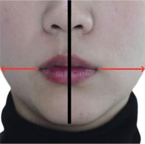 Deformation Of Facial Contour