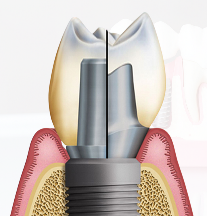 Dental Implant Cost Meiplus Dentalcare Singapore