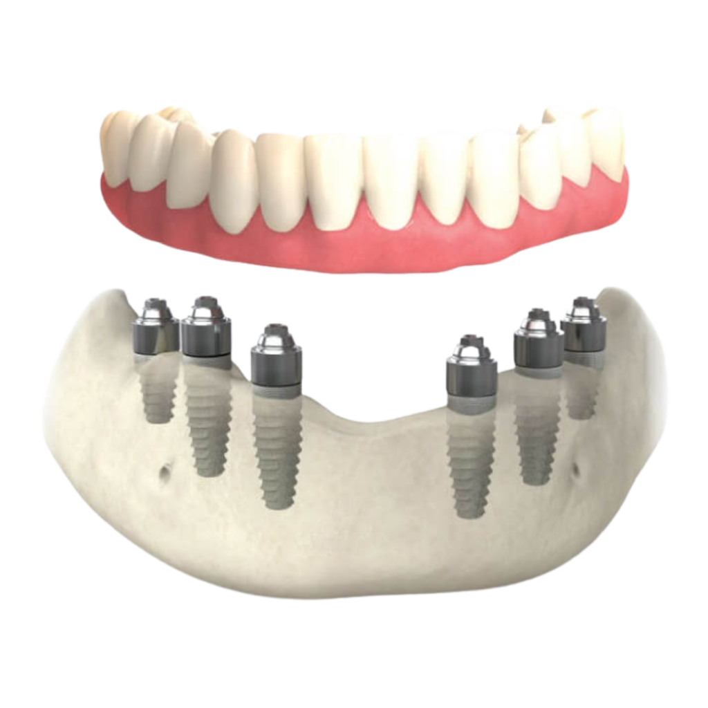 full mouth implants all on 6 singapore