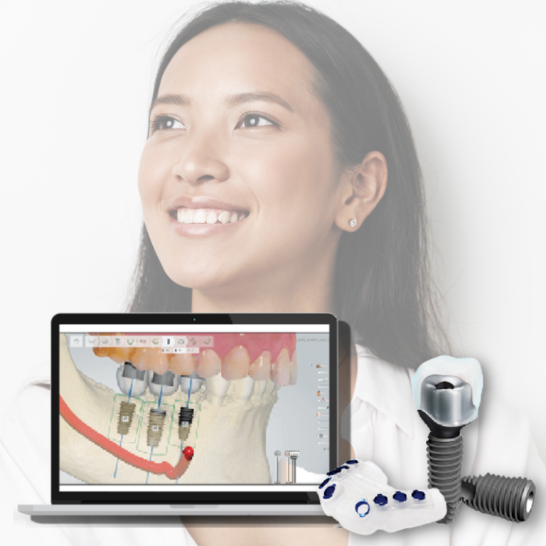 Digital Guided Dental Implants Singapore - Meiplus Dentalcare