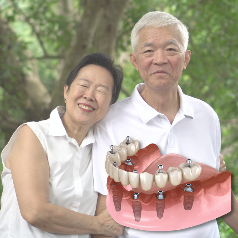 all on 6 dental implants in Singapore