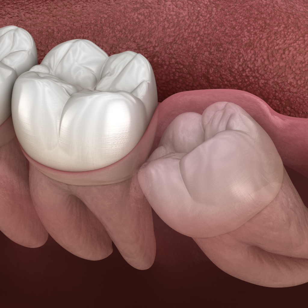 wisdom tooth extraction Singapore