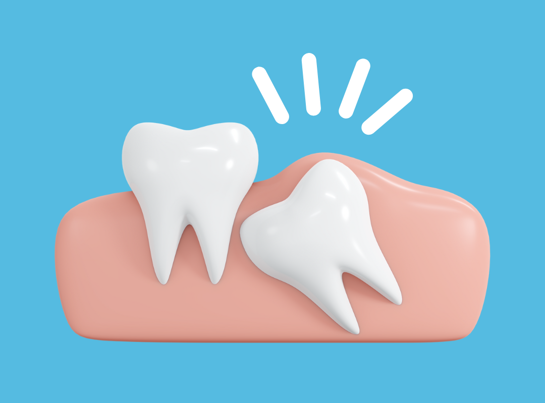impacted wisdom tooth removal singapore
