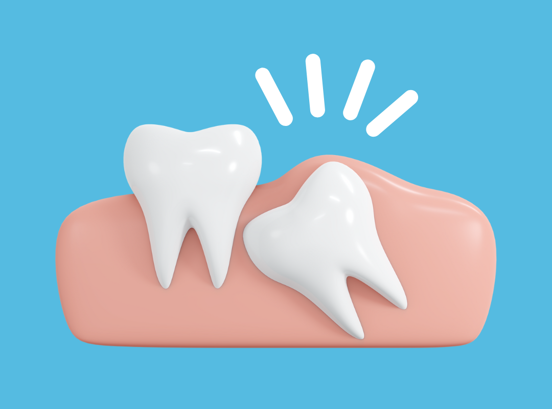 impacted wisdom tooth extraction singapore