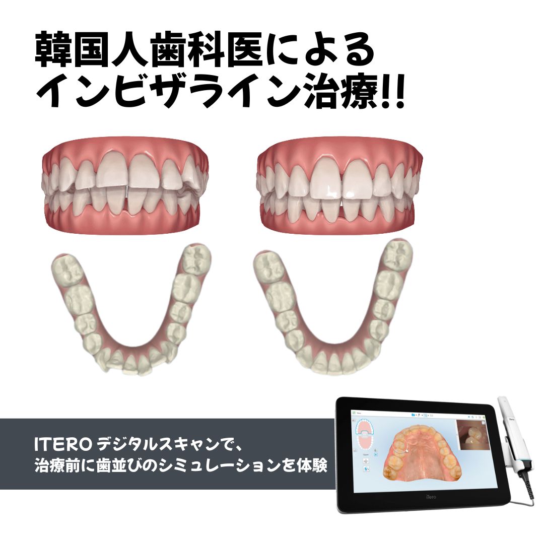 iTero デジタルスキャンで、治療前に歯並びのシミュレーションを体験