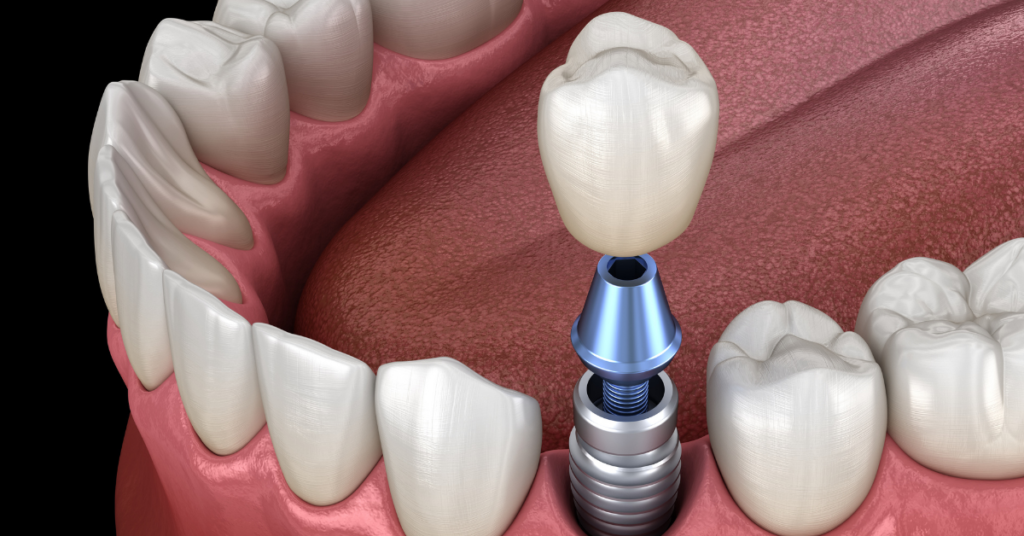 Dental Implants Immediately After Tooth Extraction