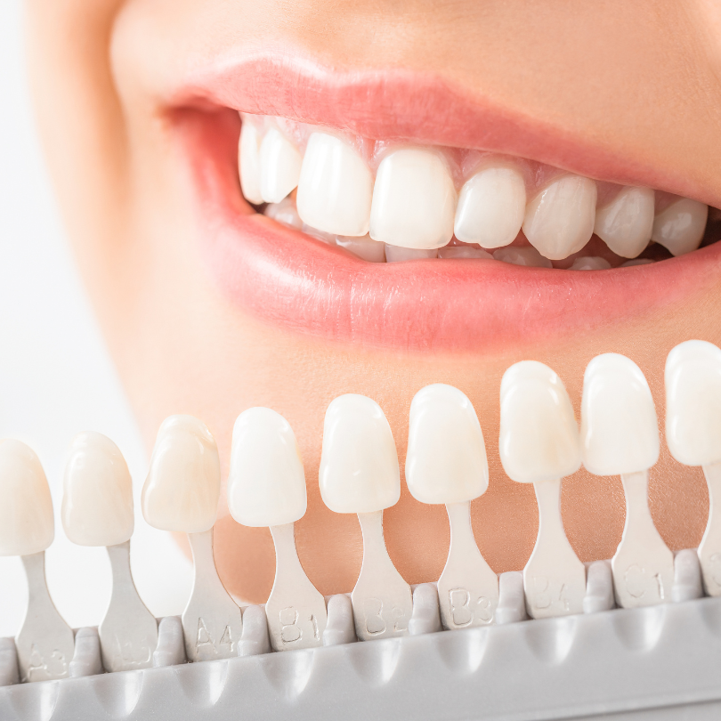 teeth whitening smile makeover Singapore