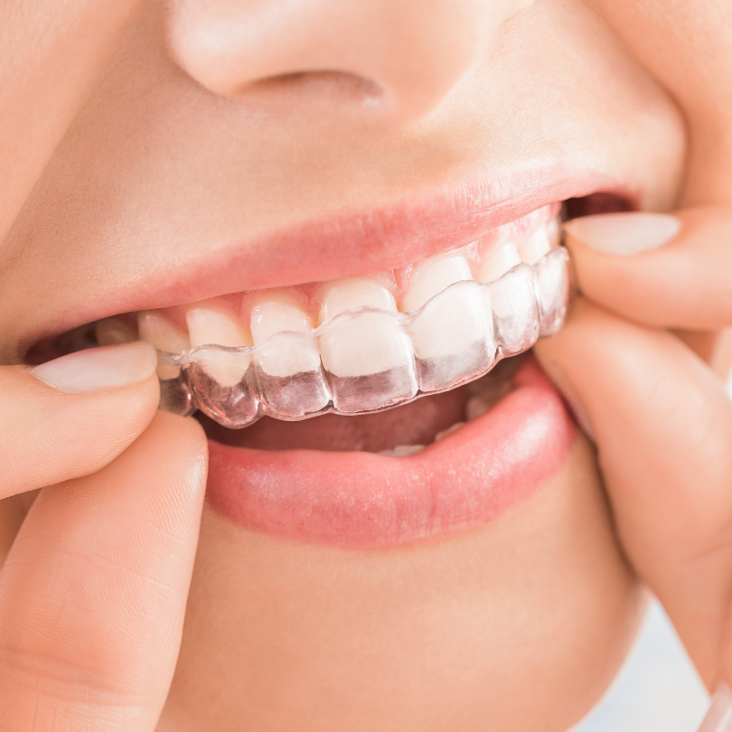 Braces and Invisalign smile makeover Singapore