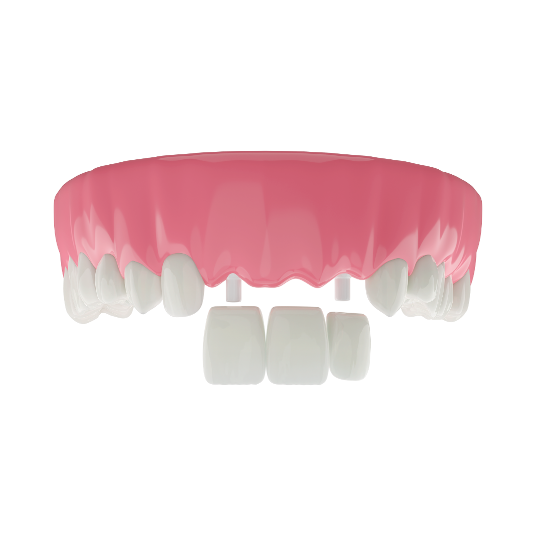 dental crown sunday
