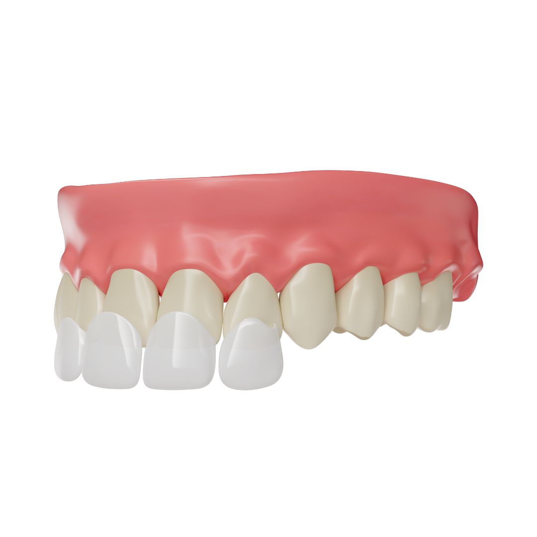 dental veneer sunday