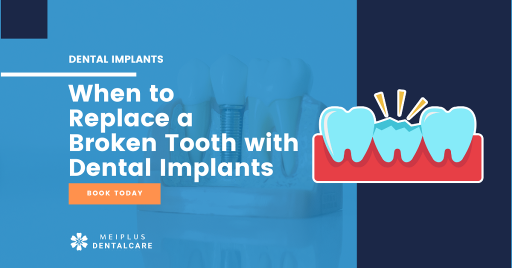 BROKEN TOOTH IMPLANTS