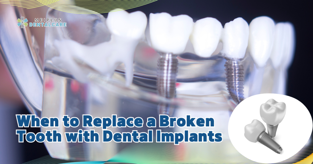 When to Replace a Broken Tooth with Dental Implants medisave