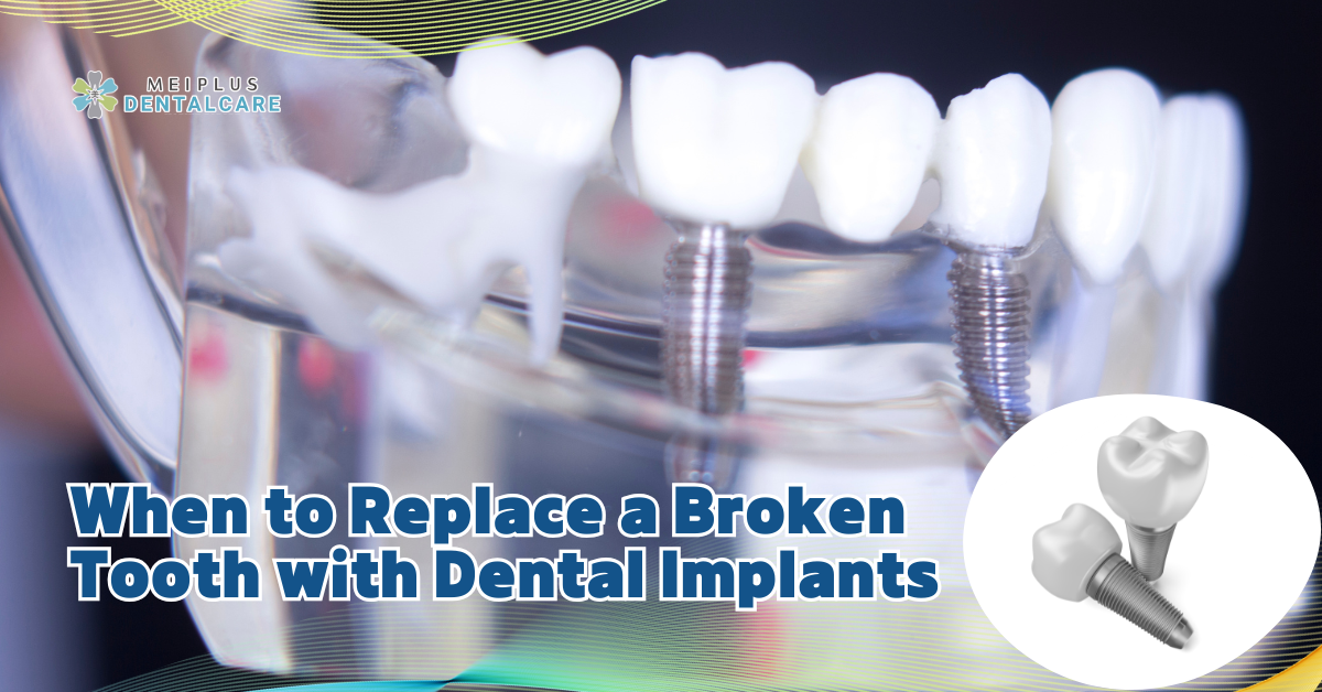 When to Replace a Broken Tooth with Dental Implants medisave