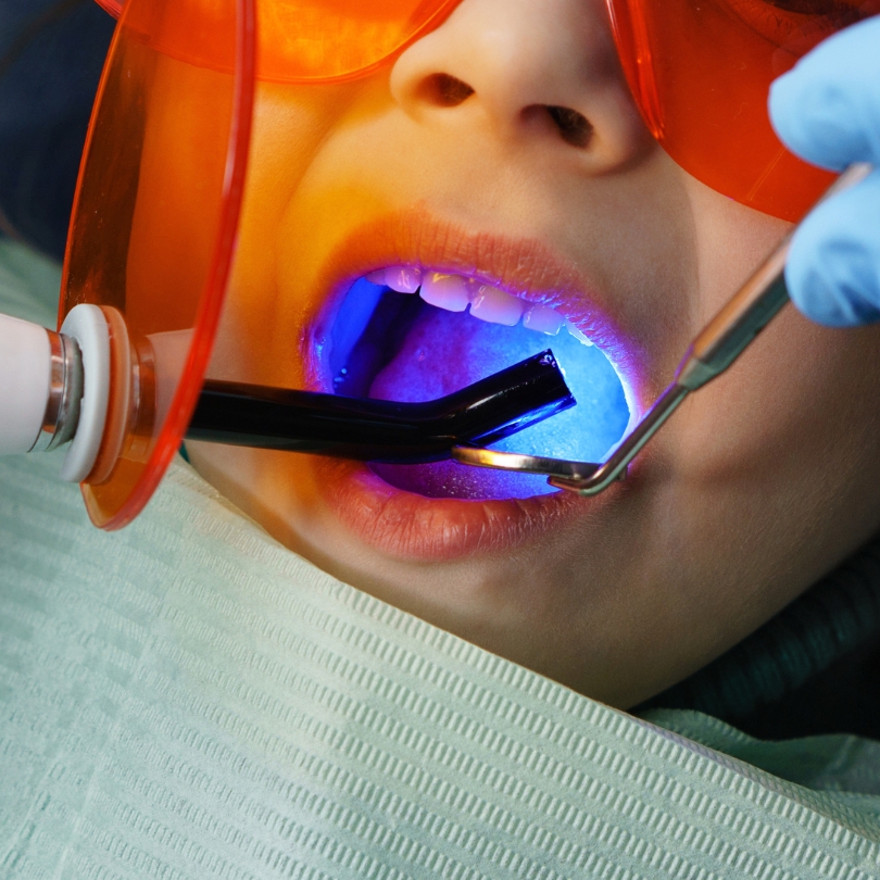Tooth fillings Singapore