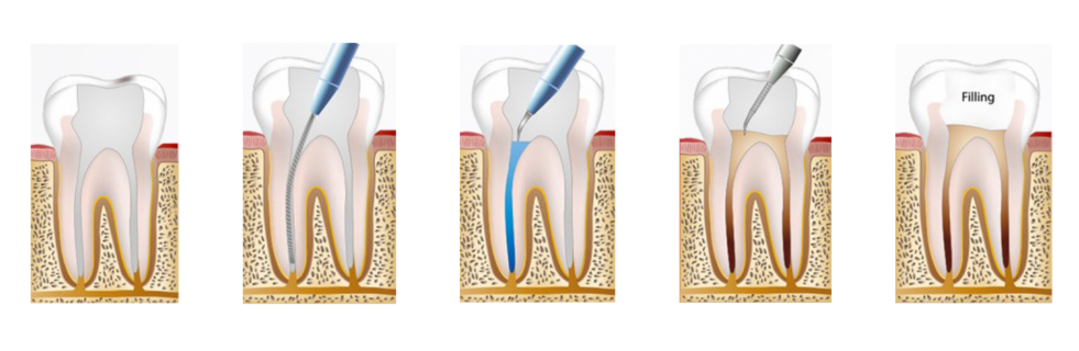 Root canal treatment Singapore