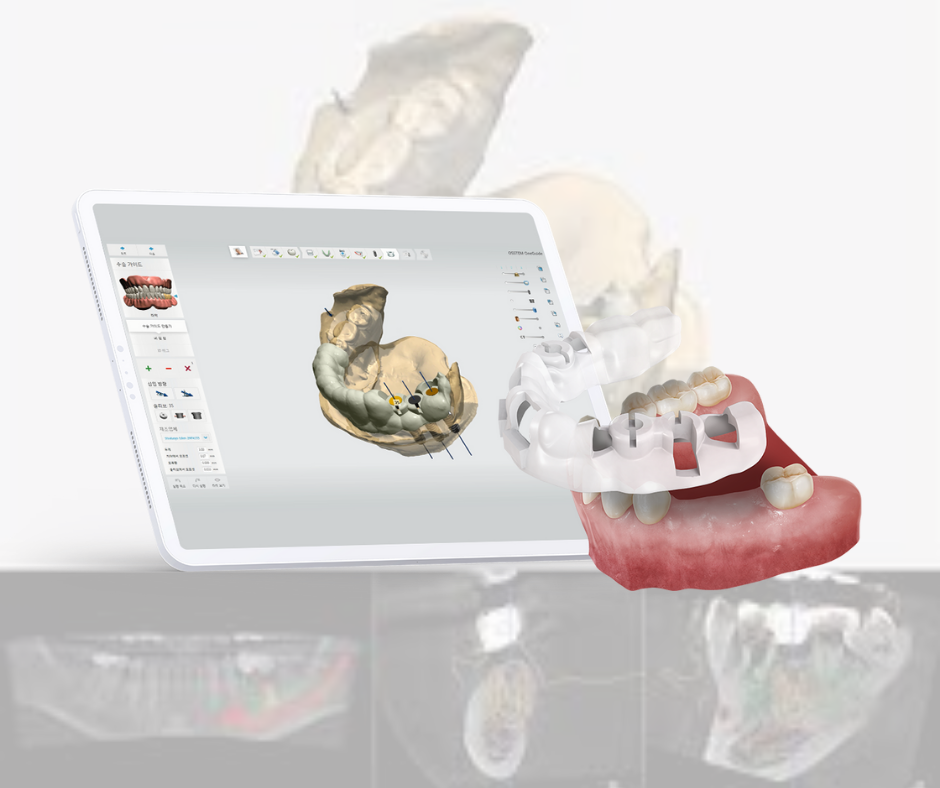 Digital Guided Dental Implants