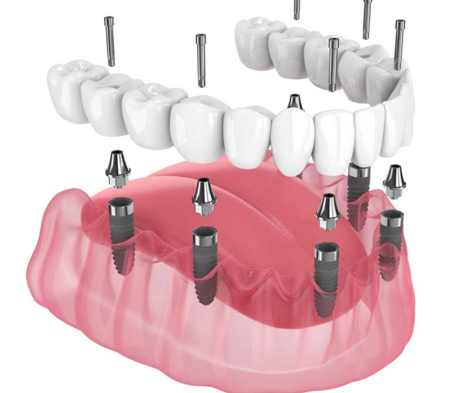 full arch implants all on 6