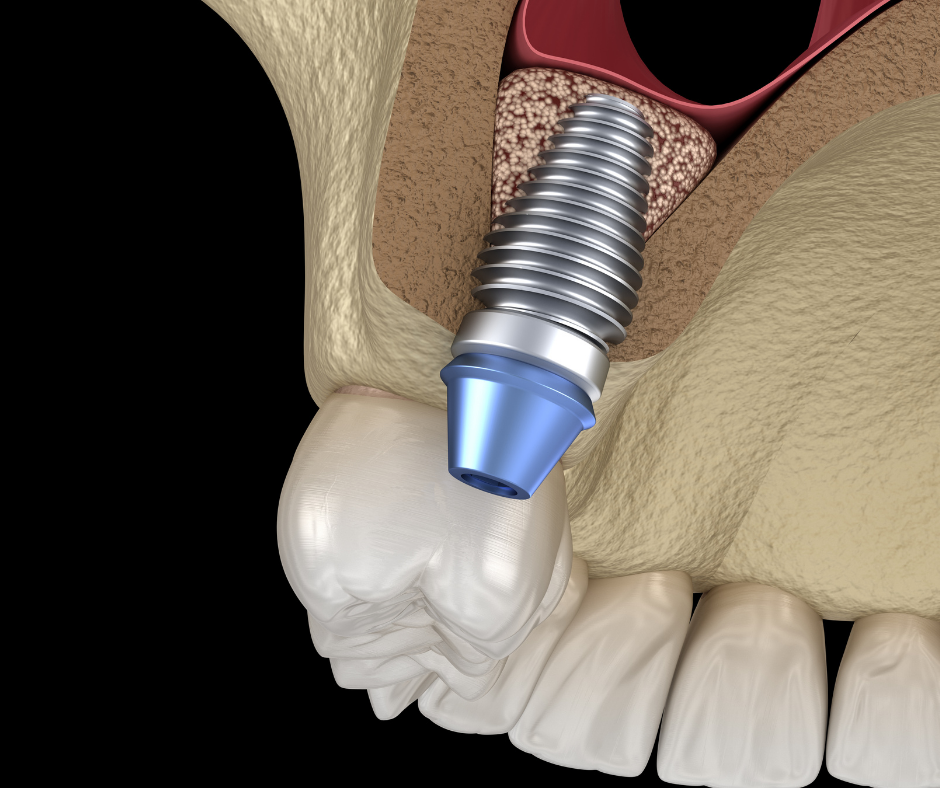 Bone Grafting