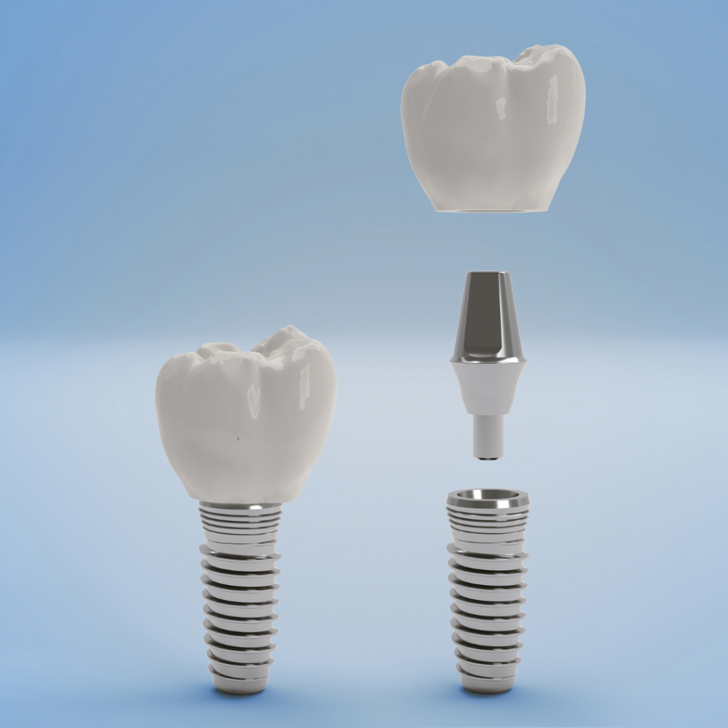 dental implant katong marine parade