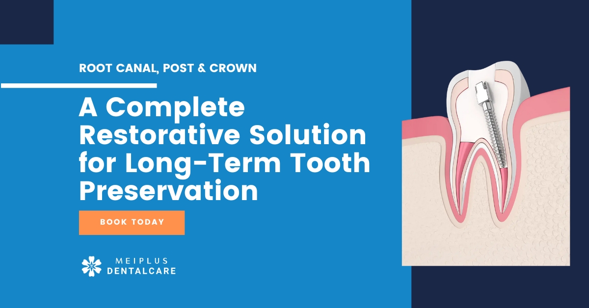 post crown after root canal treatment