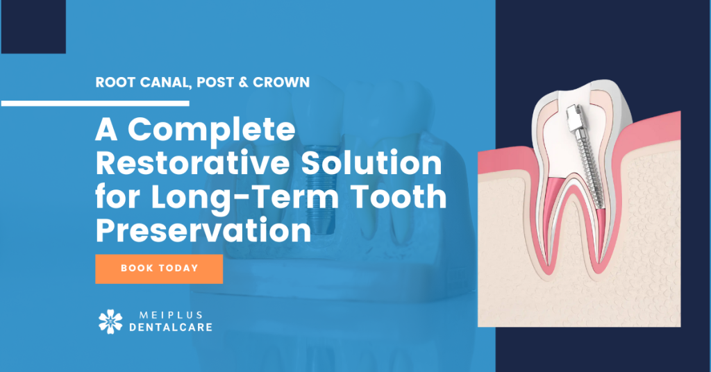 Post Crown After Root Canal Treatment: Why It May Be Recommended 1 Post Crown After Root Canal Treatment: When & Why It’s Recommended