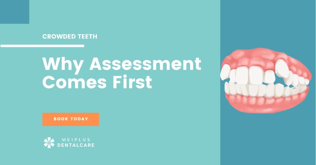 crowded teeth invisalign singapore