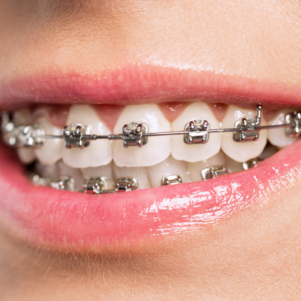 metal braces metal braces