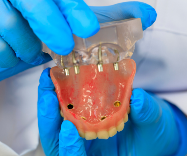 overdentures cost singapore overdentures cost singapore