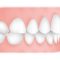 Jaw Misalignment