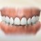 Overbite or Underbite