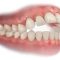 Open Bite or Crossbite